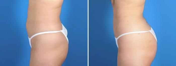 Before & After Liposuction Case 25665 View #3 View in Alpharetta, GA