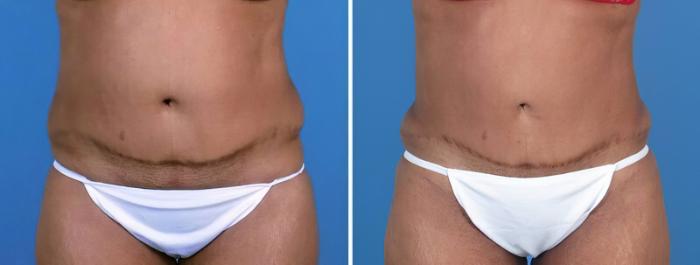 Before & After Liposuction Case 25670 View #2 View in Alpharetta, GA