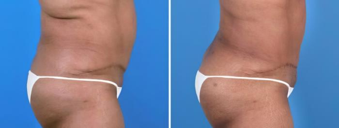 Before & After Liposuction Case 25670 View #3 View in Alpharetta, GA