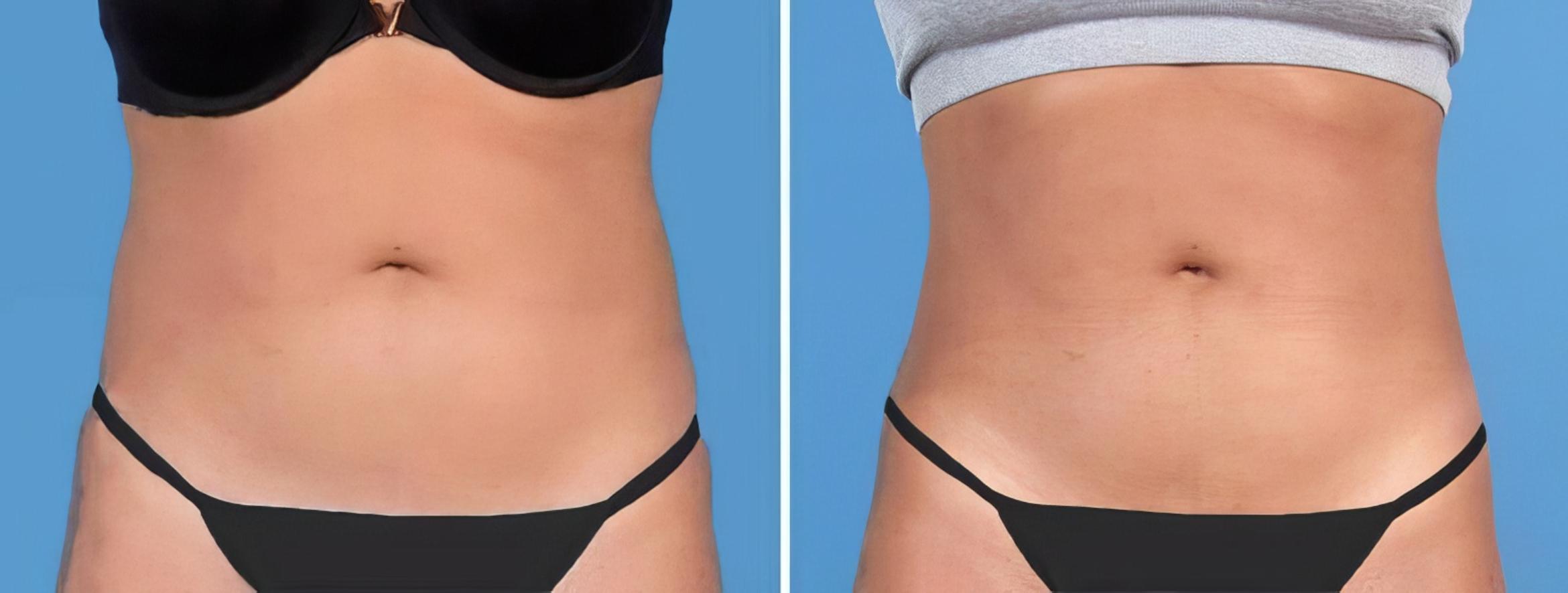 Before & After Liposuction Case 25769 View #1 View in Alpharetta, GA