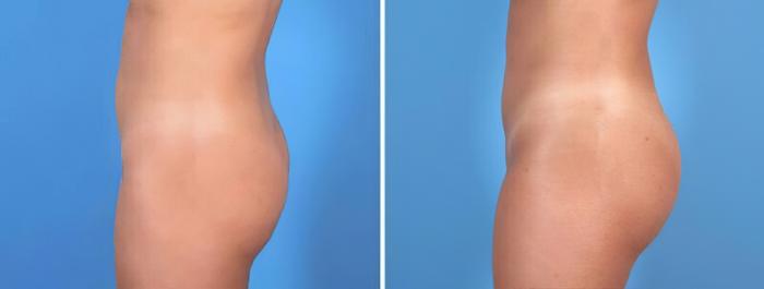 Before & After Liposuction Case 25769 View #2 View in Alpharetta, GA