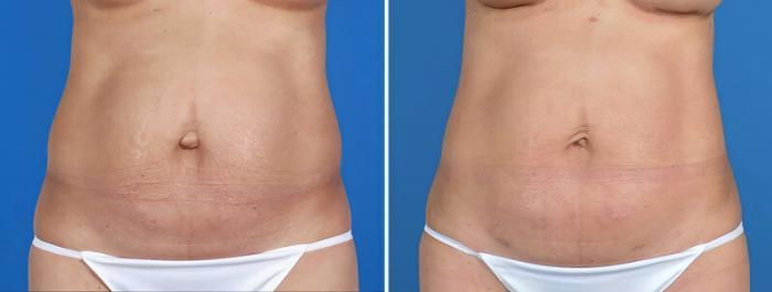 Before & After Liposuction Case 25814 View #1 View in Alpharetta, GA