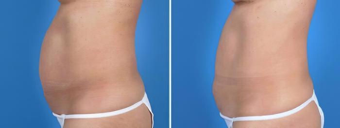Before & After Liposuction Case 25814 View #2 View in Alpharetta, GA