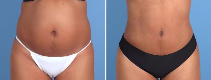 Before & After Liposuction Case 26701 View #1 View in Alpharetta, GA