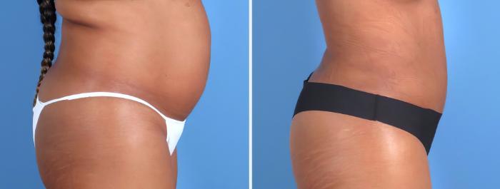 Before & After Liposuction Case 26701 View #2 View in Alpharetta, GA