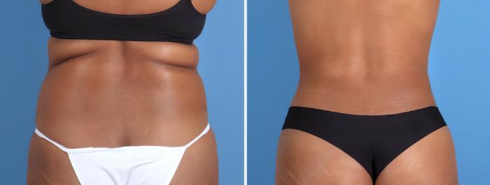 Before & After Liposuction Case 26701 View #3 View in Alpharetta, GA
