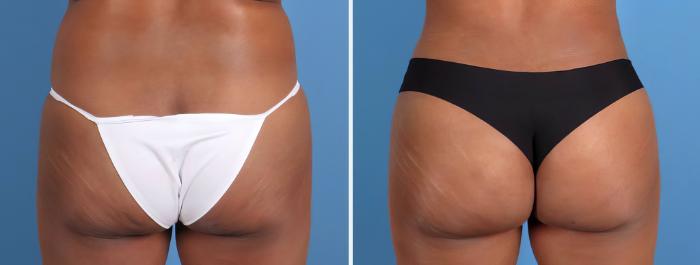 Before & After Liposuction Case 26701 View #4 View in Alpharetta, GA