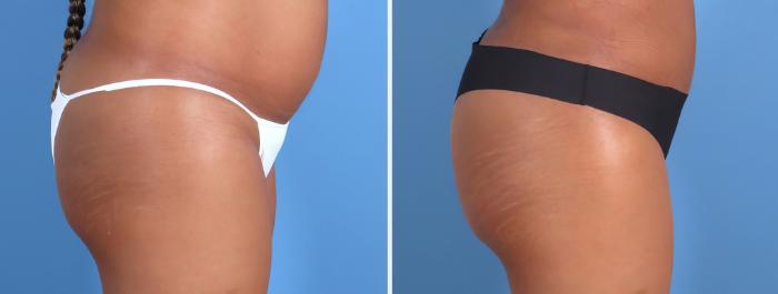 Before & After Liposuction Case 26701 View #5 View in Alpharetta, GA