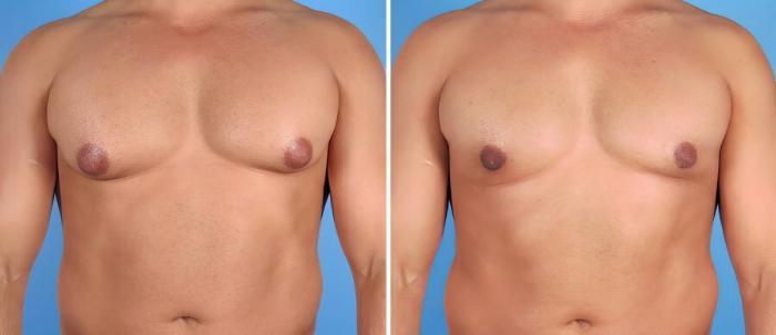 Before & After Male Breast Reduction Case 17355 View #1 View in Alpharetta, GA