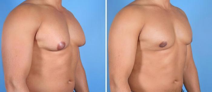 Before & After Male Breast Reduction Case 17355 View #2 View in Alpharetta, GA