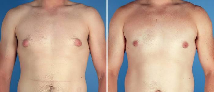 Before & After Male Breast Reduction Case 17370 View #1 View in Alpharetta, GA