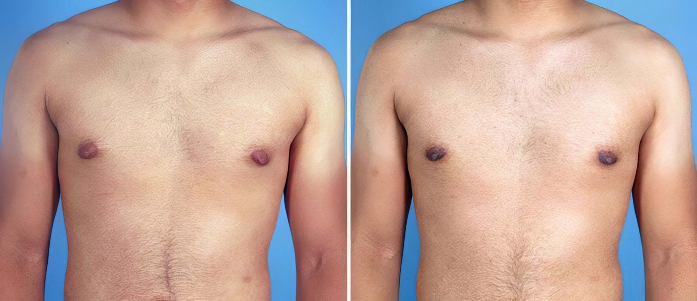 Before & After Male Breast Reduction Case 19535 View #1 View in Alpharetta, GA