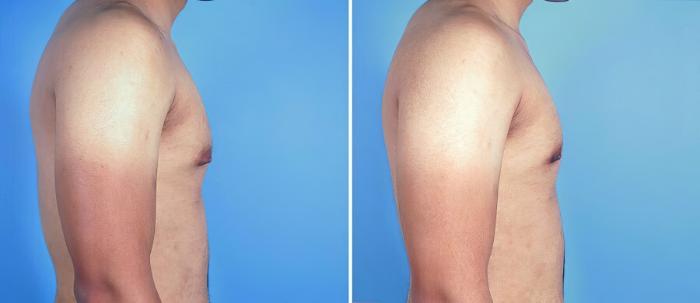 Before & After Male Breast Reduction Case 19535 View #2 View in Alpharetta, GA