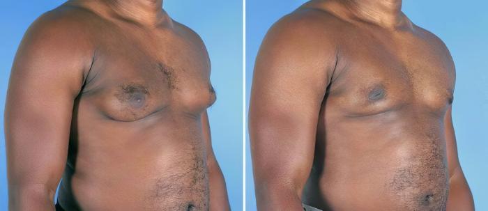 Before & After Male Breast Reduction Case 19538 View #1 View in Alpharetta, GA
