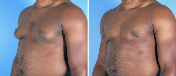 Before & After Male Breast Reduction Case 19538 View #2 View in Alpharetta, GA