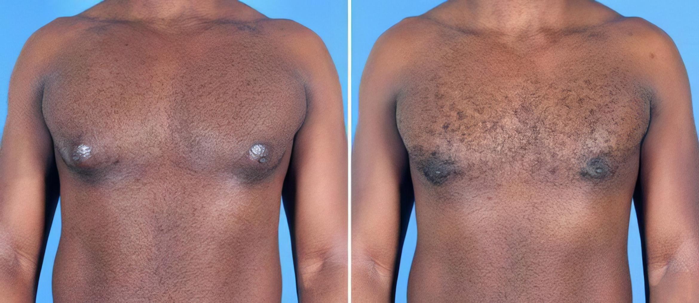 Before & After Male Breast Reduction Case 25627 View #1 View in Alpharetta, GA