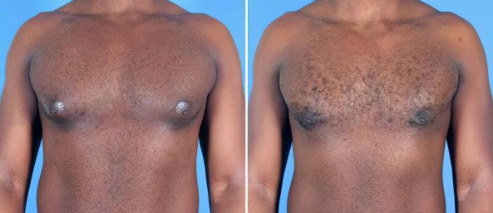 Before & After Male Breast Reduction Case 25627 View #1 View in Alpharetta, GA