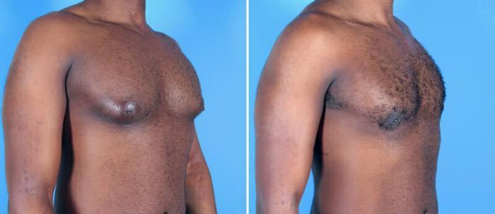 Before & After Male Breast Reduction Case 25627 View #2 View in Alpharetta, GA