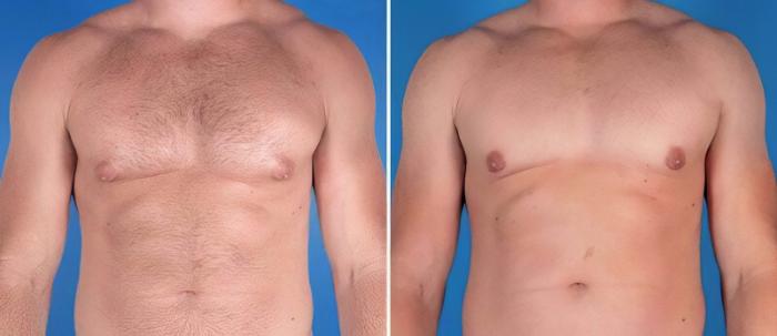 Before & After Male Breast Reduction Case 25631 View #1 View in Alpharetta, GA