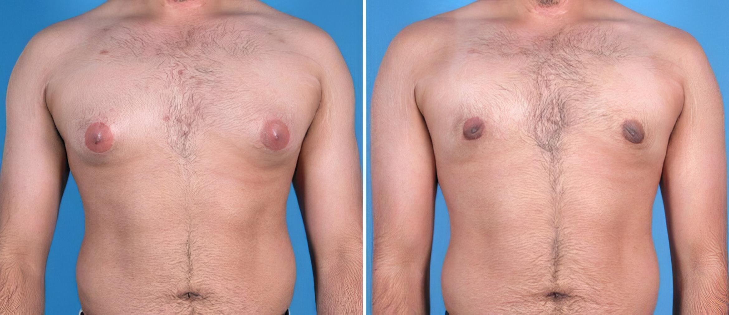 Before & After Male Breast Reduction Case 25633 View #1 View in Alpharetta, GA