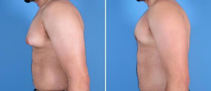 Before & After Male Breast Reduction Case 25633 View #2 View in Alpharetta, GA