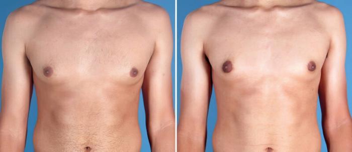 Before & After Male Breast Reduction Case 25636 View #1 View in Alpharetta, GA