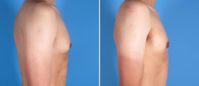 Before & After Male Breast Reduction Case 25636 View #2 View in Alpharetta, GA