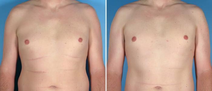 Before & After Male Breast Reduction Case 25776 View #1 View in Alpharetta, GA