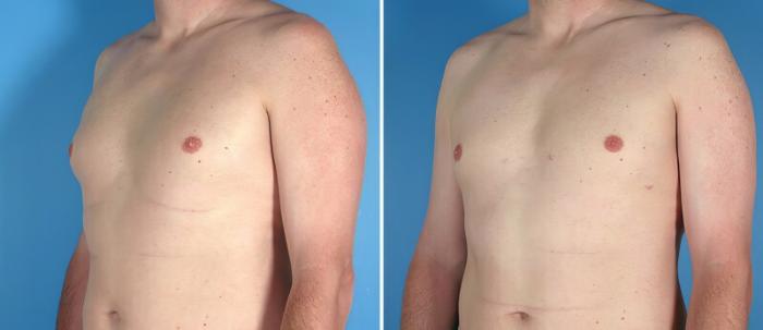 Before & After Male Breast Reduction Case 25776 View #2 View in Alpharetta, GA