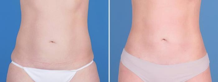 Before & After Mini Tummy Tuck Case 25170 View #1 View in Alpharetta, GA