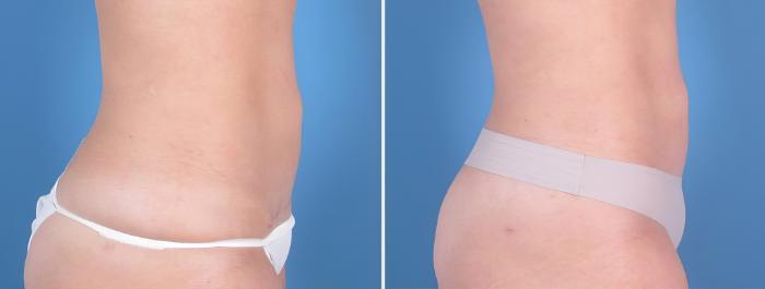Before & After Mini Tummy Tuck Case 25170 View #2 View in Alpharetta, GA