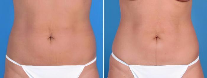 Before & After Mini Tummy Tuck Case 25683 View #1 View in Alpharetta, GA