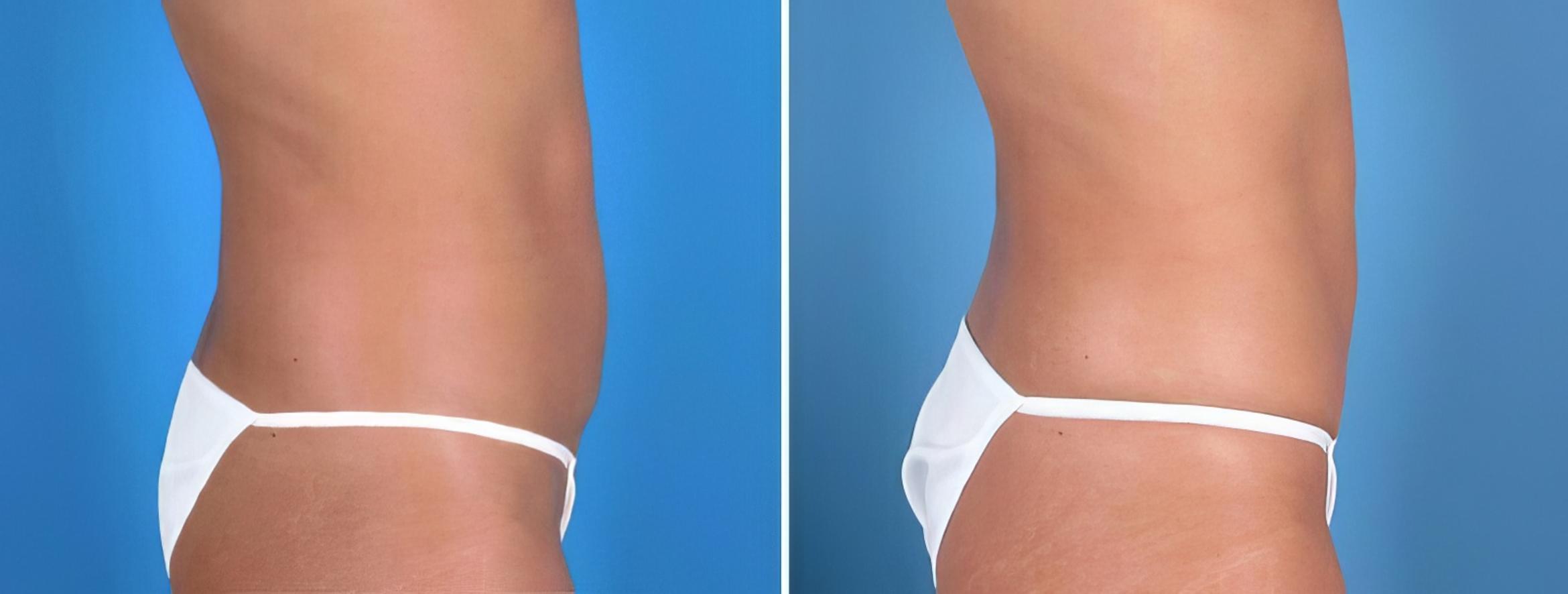 Mini Tummy Tuck Before And After Pictures Case 25683 Alpharetta Ga The Swan Center For