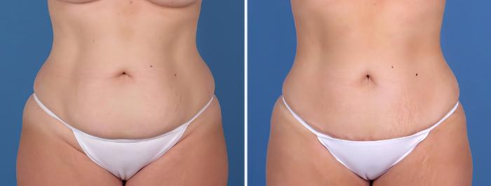 Before & After Mini Tummy Tuck Case 26798 View #1 View in Alpharetta, GA