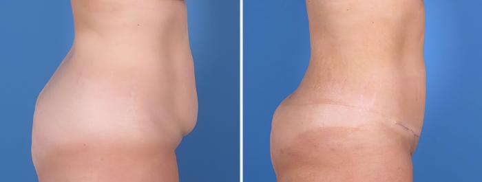 Before & After Mini Tummy Tuck Case 26798 View #2 View in Alpharetta, GA