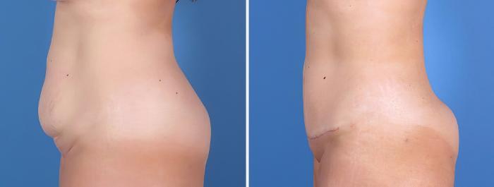 Before & After Mini Tummy Tuck Case 26798 View #3 View in Alpharetta, GA