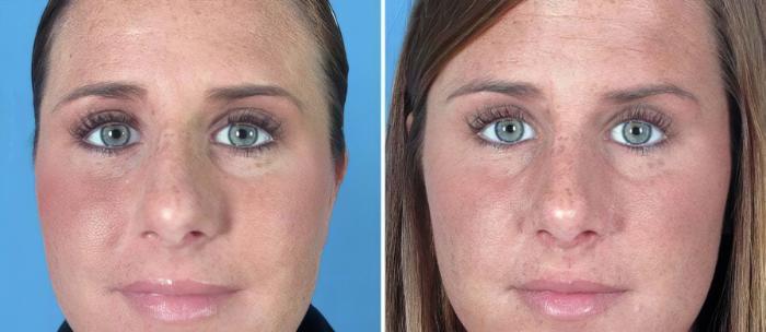 Before & After Rhinoplasty Case 17664 View #1 View in Alpharetta, GA