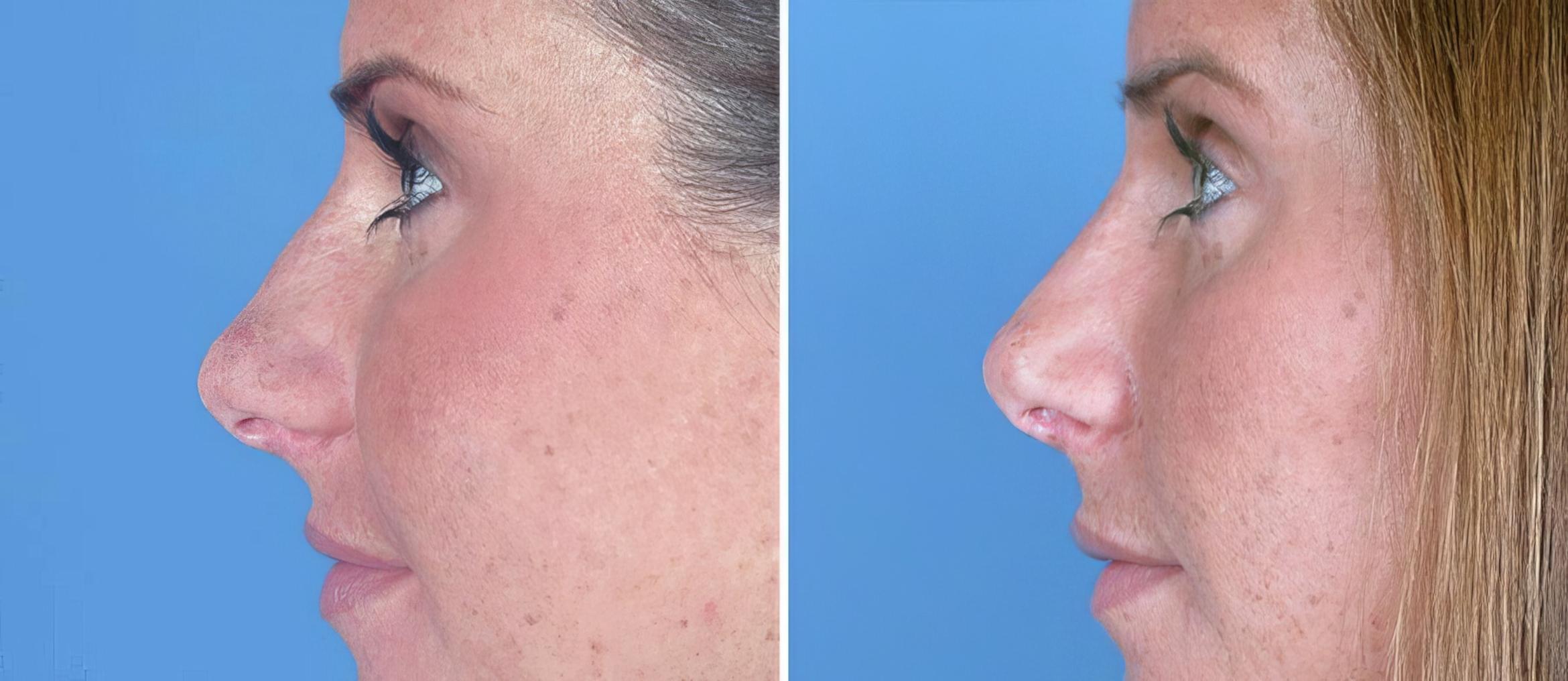 Before & After Rhinoplasty Case 17664 View #2 View in Alpharetta, GA