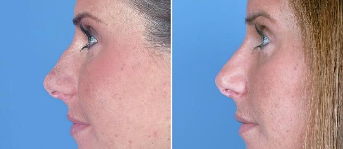 Before & After Rhinoplasty Case 17664 View #2 View in Alpharetta, GA