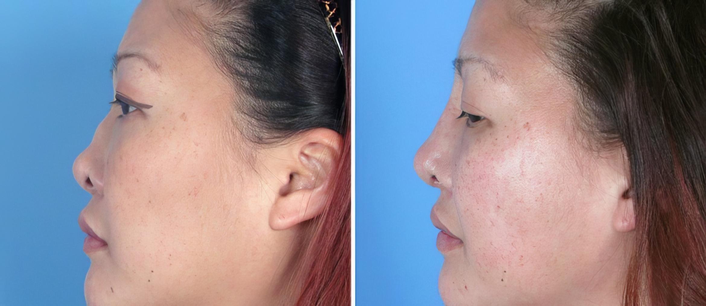 Before & After Rhinoplasty Case 17673 View #2 View in Atlanta, GA