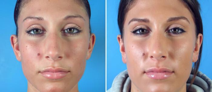 Before & After Rhinoplasty Case 17676 View #1 View in Alpharetta, GA