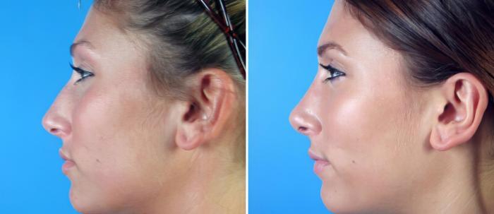 Before & After Rhinoplasty Case 17676 View #2 View in Alpharetta, GA
