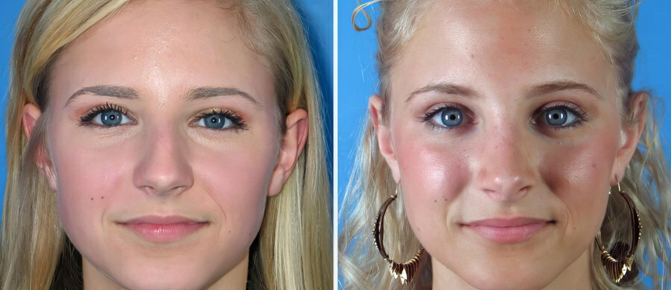 Before & After Rhinoplasty Case 17679 View #1 View in Alpharetta, GA