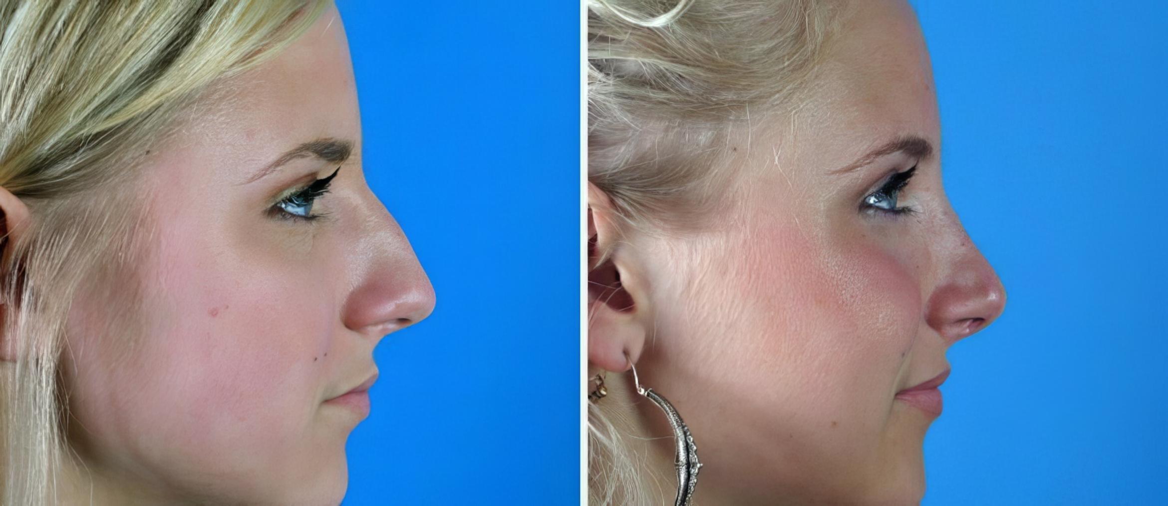 Before & After Rhinoplasty Case 17679 View #2 View in Alpharetta, GA