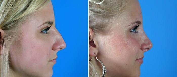 Before & After Rhinoplasty Case 17679 View #2 View in Alpharetta, GA