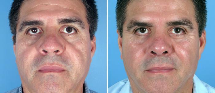 Before & After Rhinoplasty Case 17682 View #1 View in Alpharetta, GA