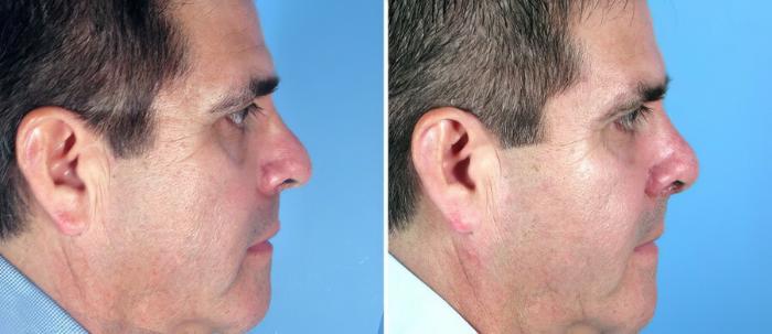 Before & After Rhinoplasty Case 17682 View #2 View in Alpharetta, GA