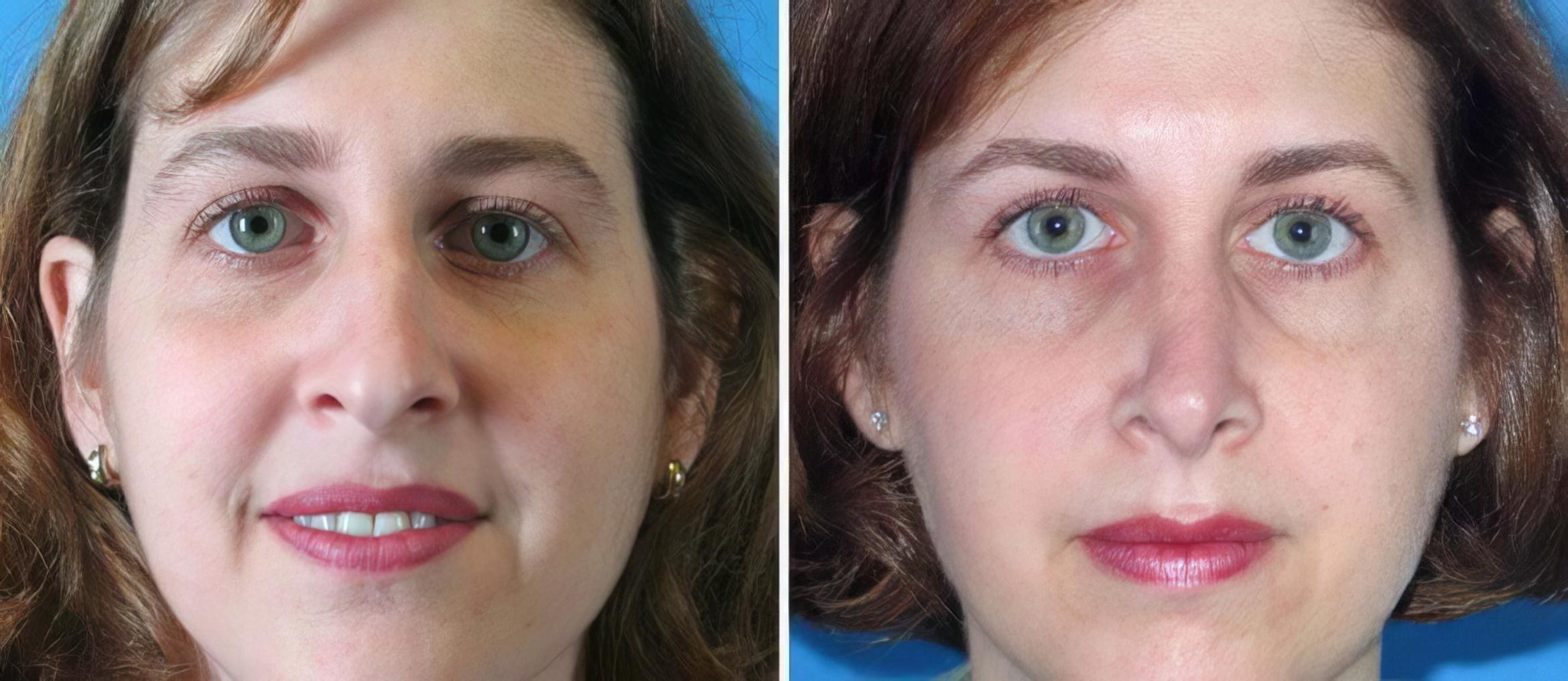 Before & After Rhinoplasty Case 17685 View #1 View in Alpharetta, GA