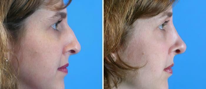 Before & After Rhinoplasty Case 17685 View #2 View in Alpharetta, GA