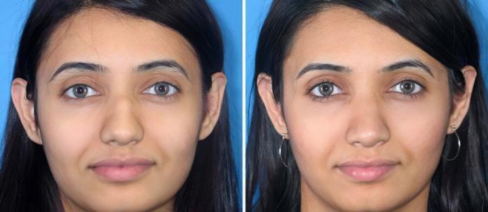Before & After Rhinoplasty Case 17688 View #1 View in Alpharetta, GA